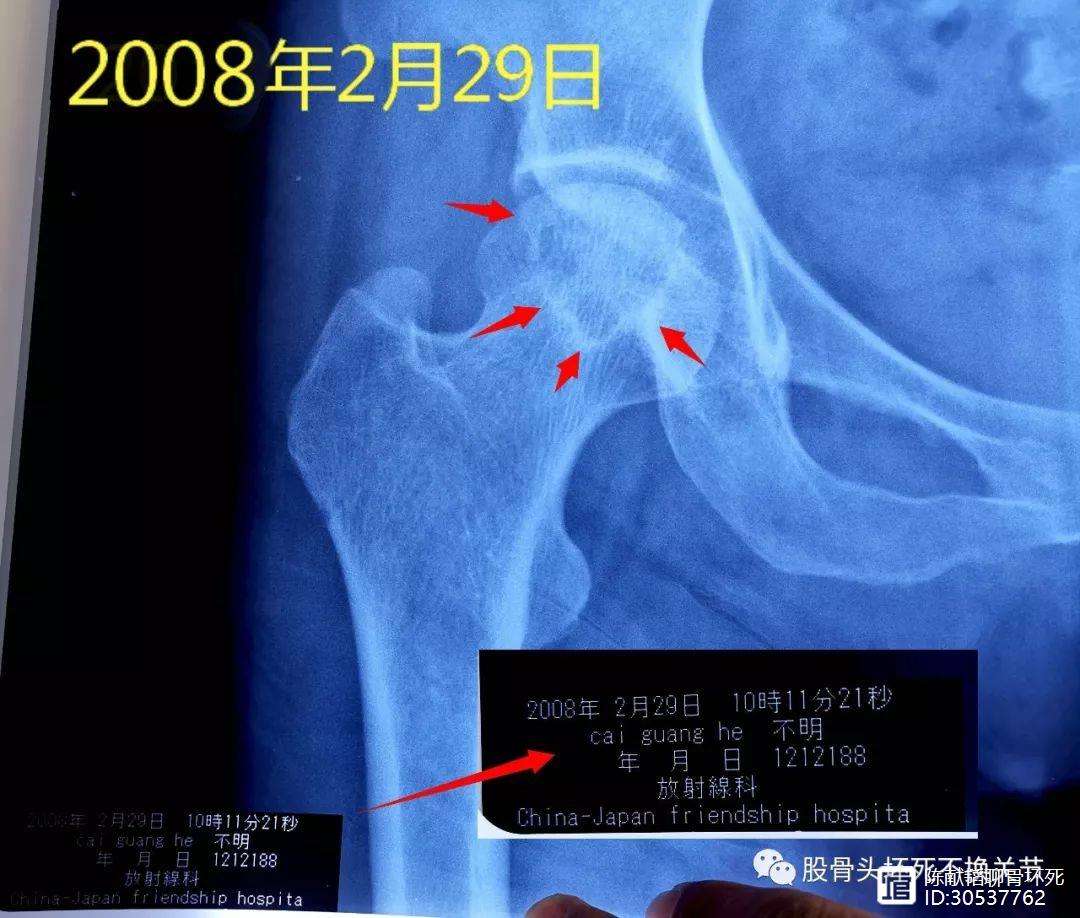 金昌人工骨头医保报销多少(人工骨头医保报销多少比例)