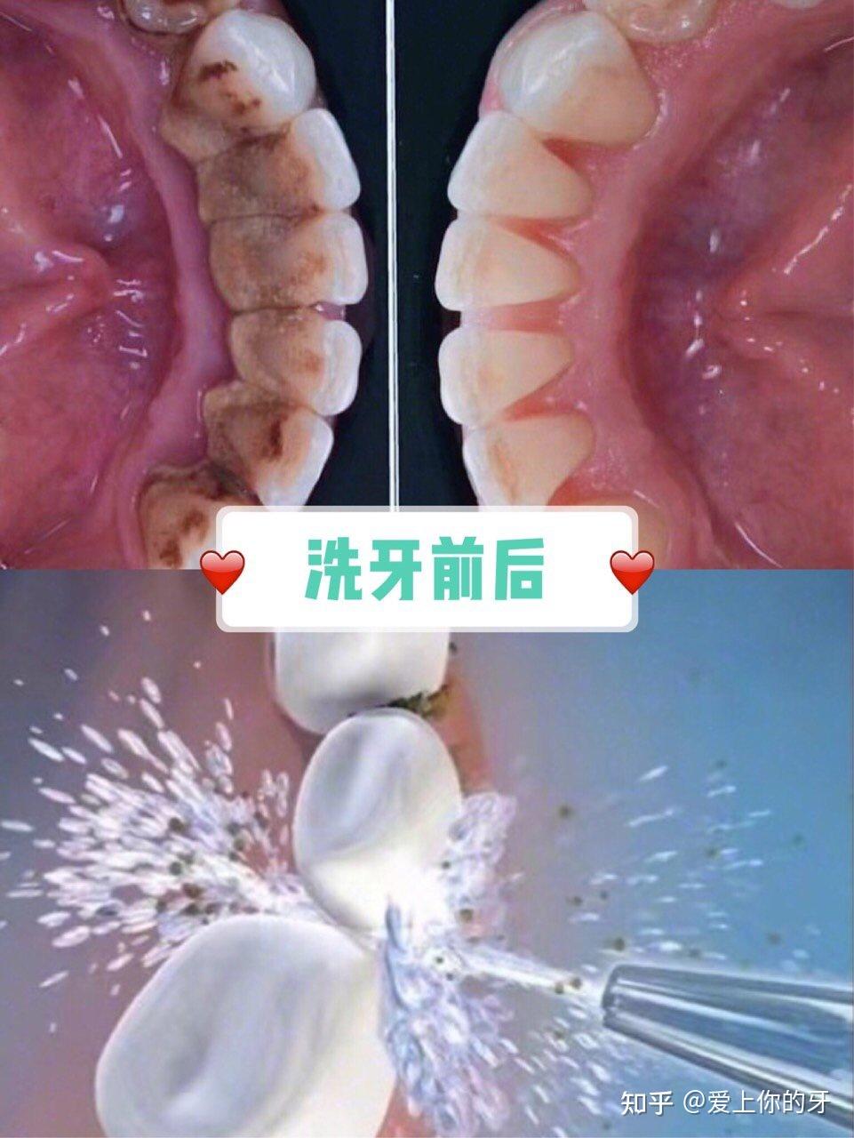 金昌洗牙可以用医保吗(洗牙可以用医保吗,报销比例多少)